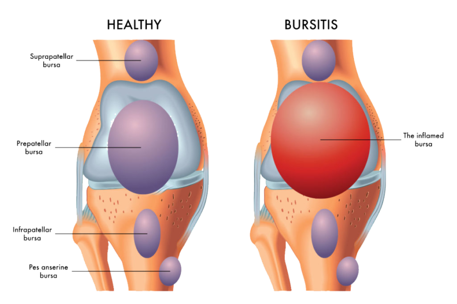 Bursa Injection Spine Care Pain Management Of San Antonio